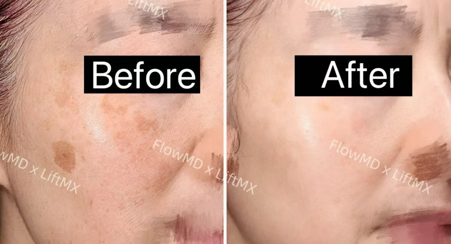 玻尿酸填充淡化细纹 · Before & After