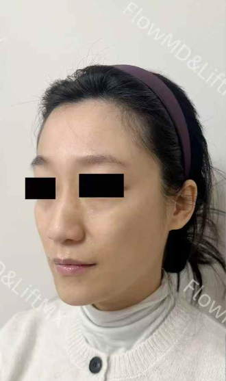 Pigmentation correction with PicoSure — before & after 2