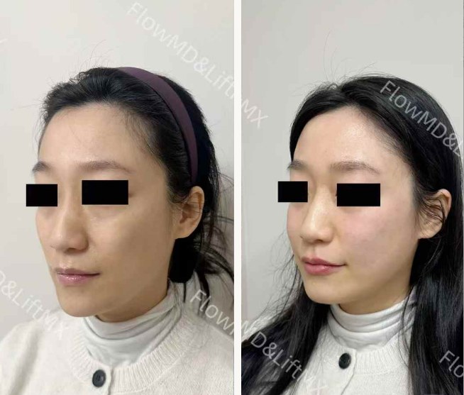Pigmentation correction with PicoSure — before & after