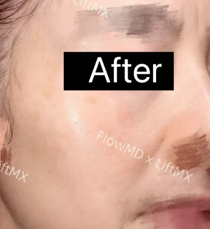 玻尿酸填充淡化细纹 · Before & After 3