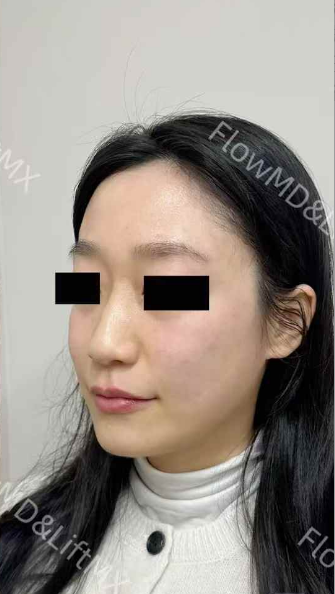 Pigmentation correction with PicoSure — before & after 3