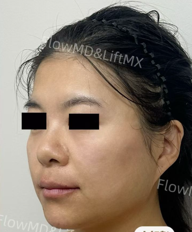 Facial contouring with HA fillers — before & after 3
