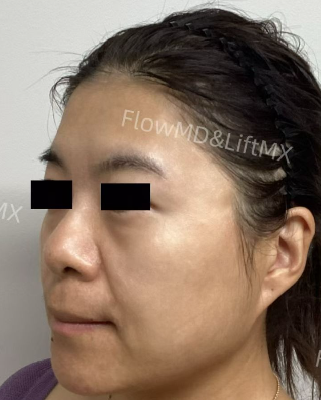 Facial contouring with HA fillers — before & after 2