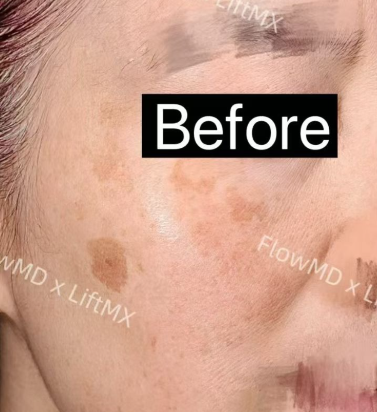 玻尿酸填充淡化细纹 · Before & After 2