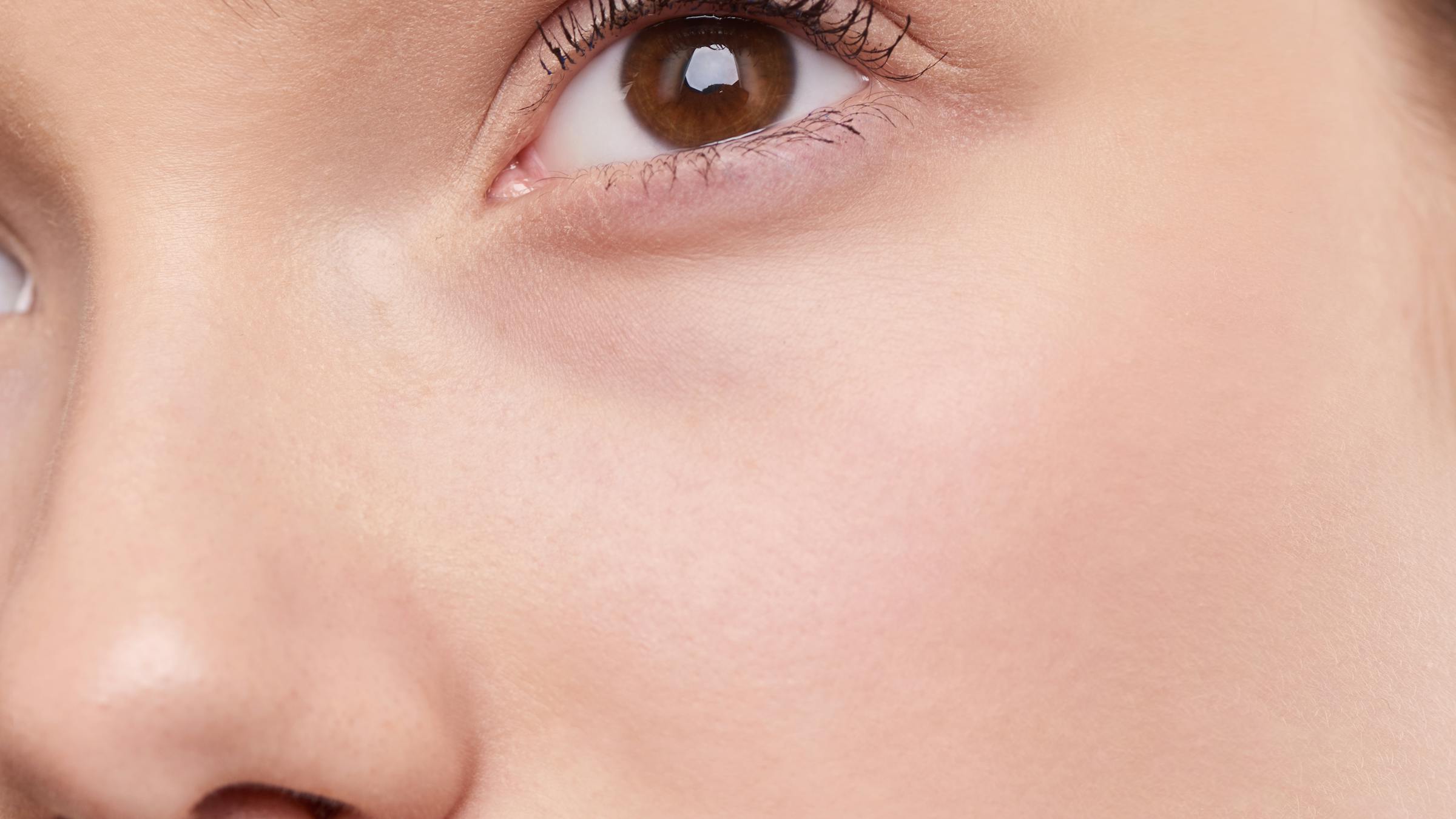 Lower Blepharoplasty