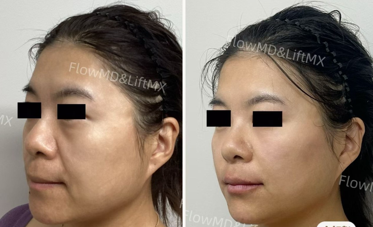Facial contouring with HA fillers — before & after